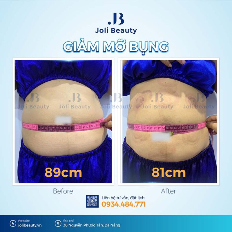 Bấm huyệt giảm mỡ bụng Đà Nẵng