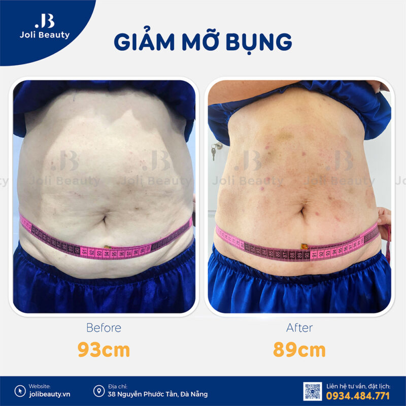 Bấm huyệt giảm mỡ bụng Đà Nẵng