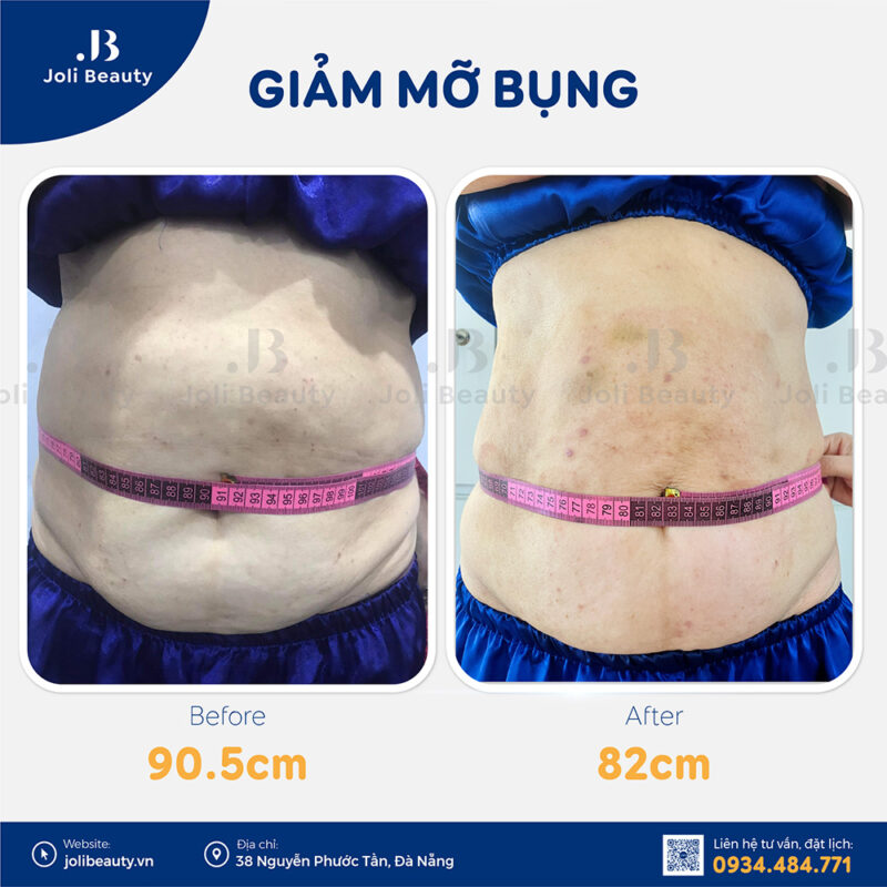 Bấm huyệt giảm mỡ bụng Đà Nẵng
