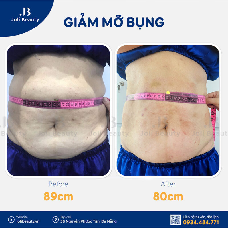 Bấm huyệt giảm mỡ bụng Đà Nẵng